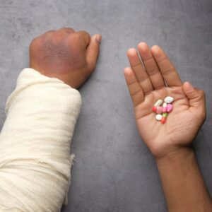 Recovering from a burn injury